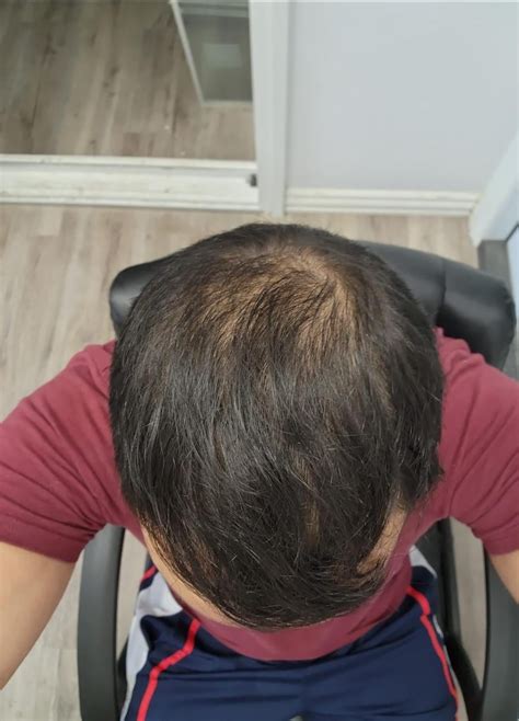 hermest hair transplant reviews reddit